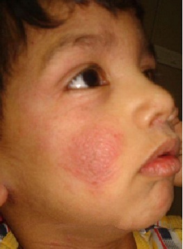 Child with eczema on face