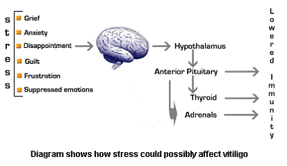 How Stress Affects Vitiligo