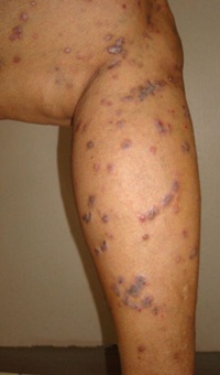 lichen planus on legs